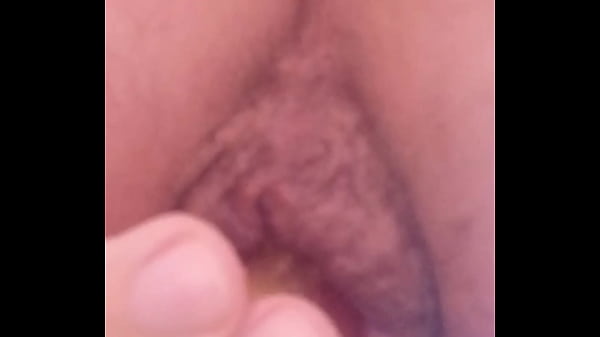 I irritating my hemorrhoidal rose to the point of gigantic prolapse