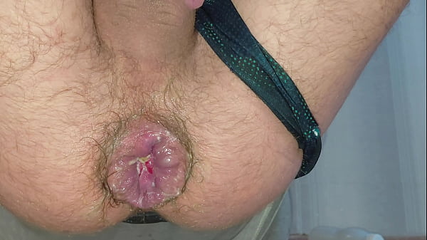A stretched anus reveals a hemorrhoidal prolapse from riding a giant bottle Amazing hardcore fisting at home